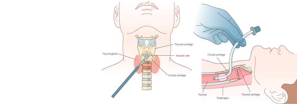 Burton Cricothyrotomy Kit